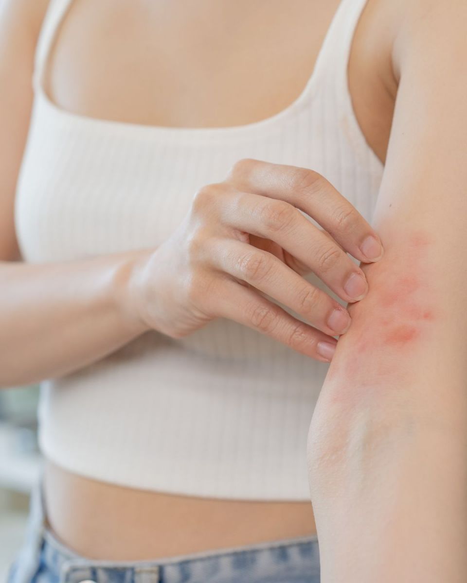 Da bị kích ứng sau khi wax sáp có chứa nhựa thông