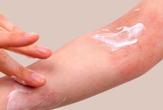 Nguy cơ dị ứng da từ sáp wax có chứa nhựa thông