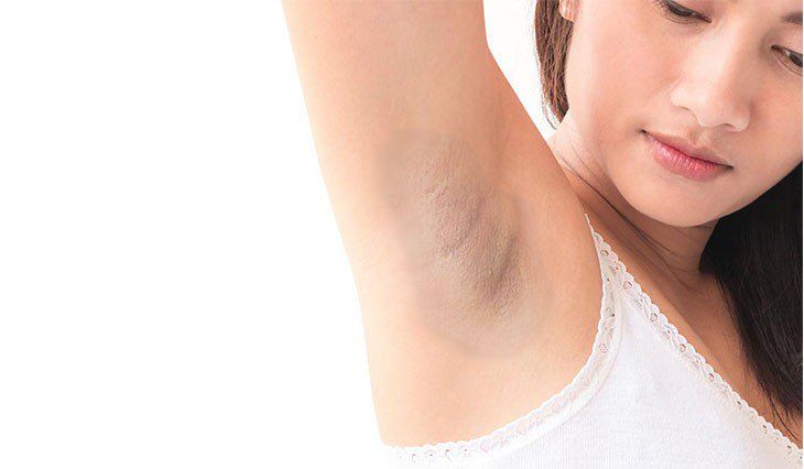 cô gái bị thâm nách, có phải do wax lông