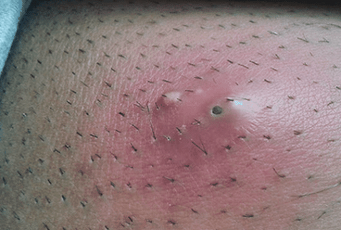 Lông mọc ngược sau wax: Nguyên nhân và cách trị dứt điểm