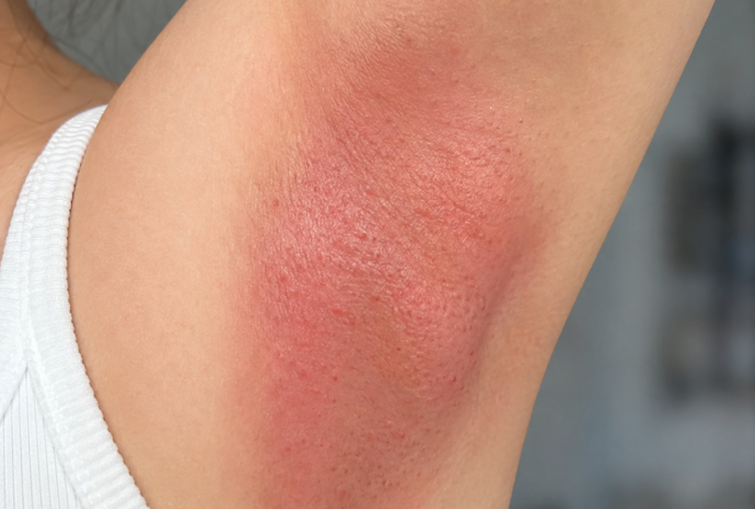 Bị rát sau khi wax lông nách: Nguyên nhân và cách khắc phục nhanh chóng