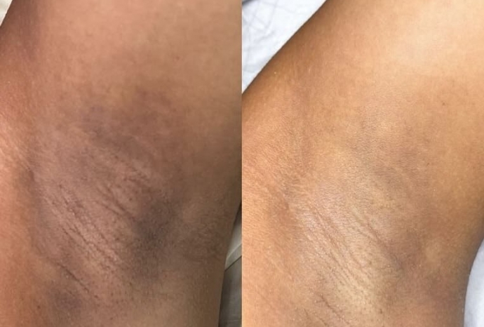 Nách bị thâm do wax? Sự thật là gì?
