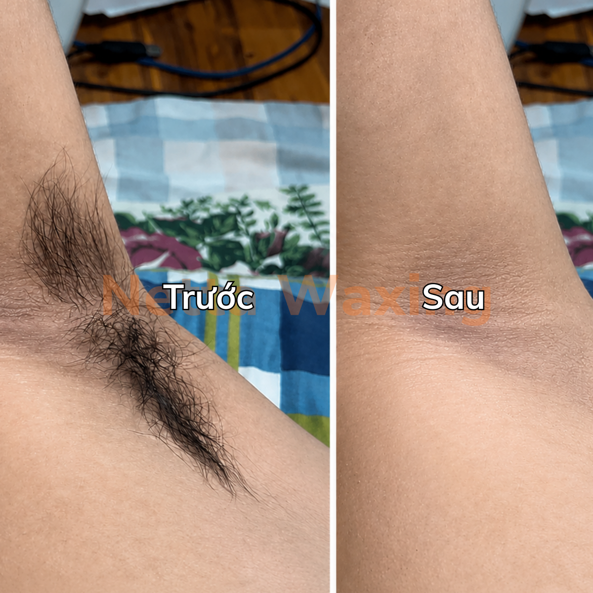 Nách trước và sau khi dùng sáp nhũ